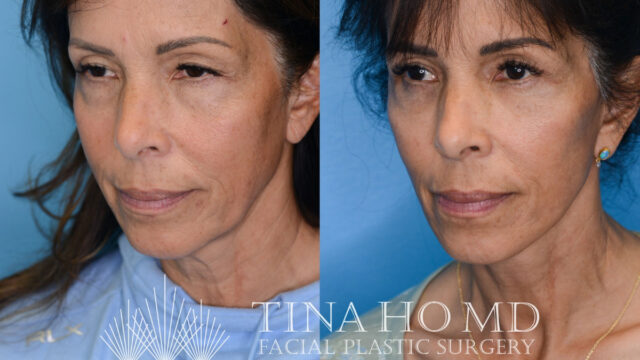 tina-ho-plastic-surgery (1)
