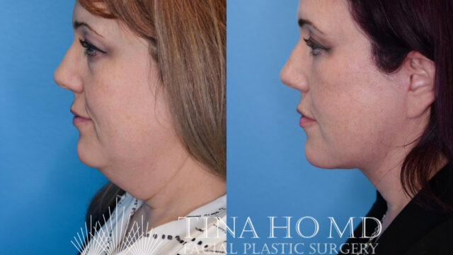 tina-ho-plastic-surgery (2)