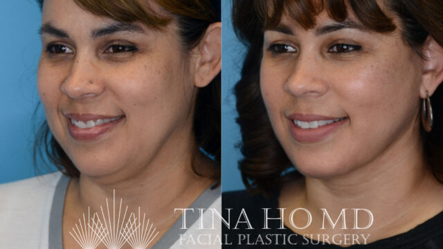 tina-ho-plastic-surgery (3)
