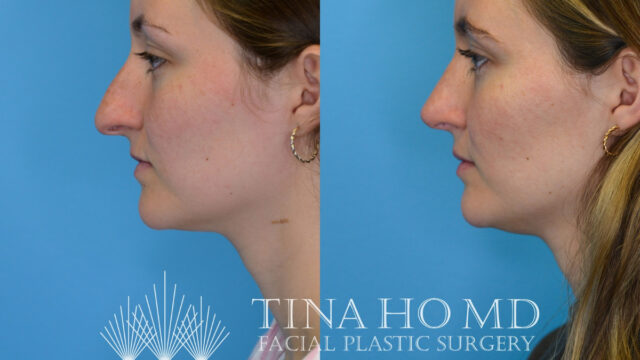 tina-ho-plastic-surgery (4)