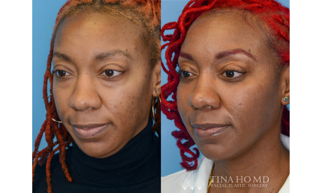 tina-ho-plastic-surgery (5)