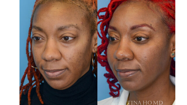 tina-ho-plastic-surgery (5)